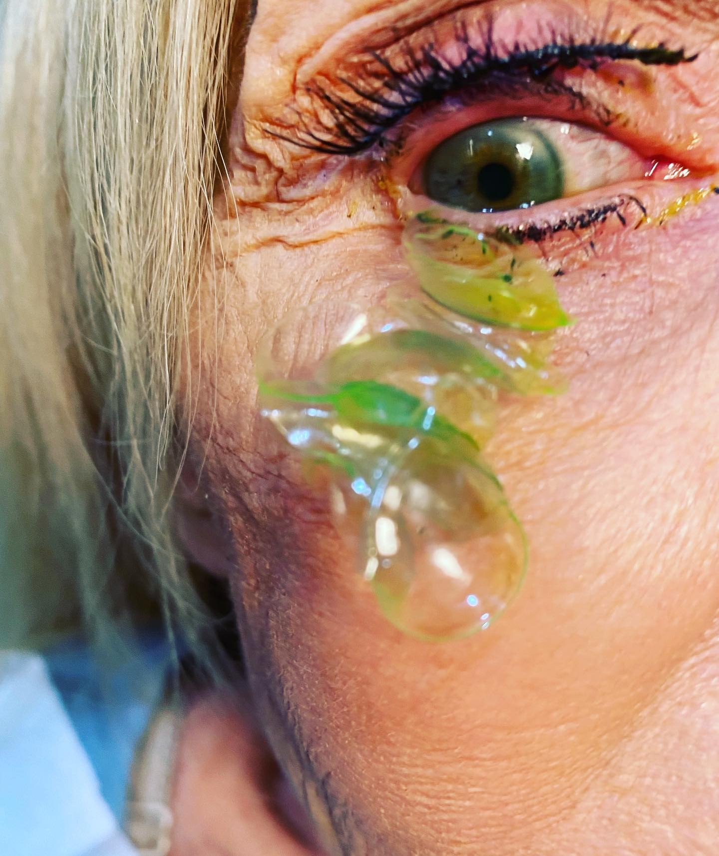 Oftamologista remove 23 lentes de contato perdidas em olho de paciente (Foto: Katerina Kurteeva/ Facebook)